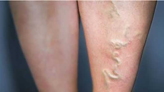 Bệnh suy giãn tĩnh mạch chi dưới